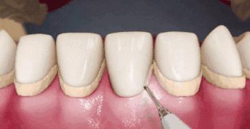 洗牙后牙缝变大了能自然恢复吗,健康洁牙和洗牙