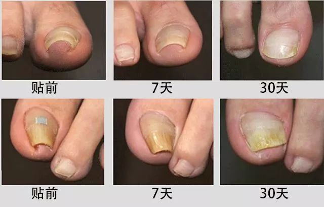 小脚趾甲长在肉里一碰就疼怎么办,指甲扎到肉里怎么处理