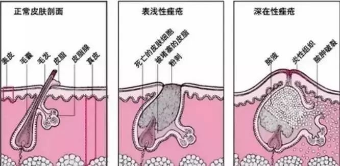 战痘神器祛痘效果怎么样,战痘神器推荐