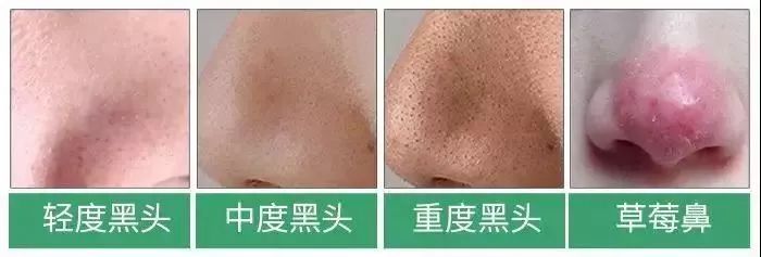 又爽又恶心的去黑头方法来了！5分钟将你10年的黑头白头连根拔起！