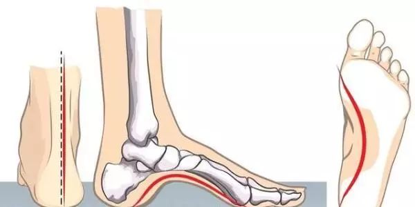 科普|脚部有五大“健康黑洞”，足踝专家为你逐一点破！