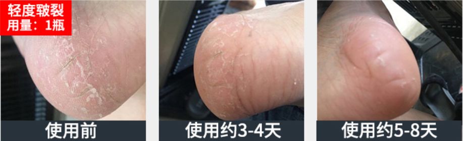 脚后跟套上这个“*钟金**罩”夏季穿鞋嫩到反光！干裂、老茧、死皮都没了！