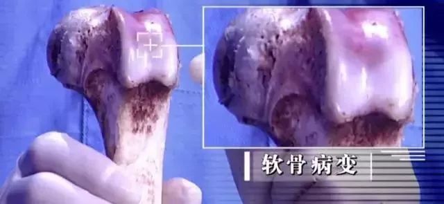 脚膝盖关节咔咔响什么原因引起的,一动身体各个关节咔咔响怎么回事