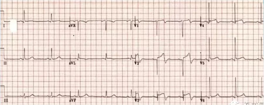 陈静：胸痛心电图的诊断与鉴别诊断｜CCIF2019