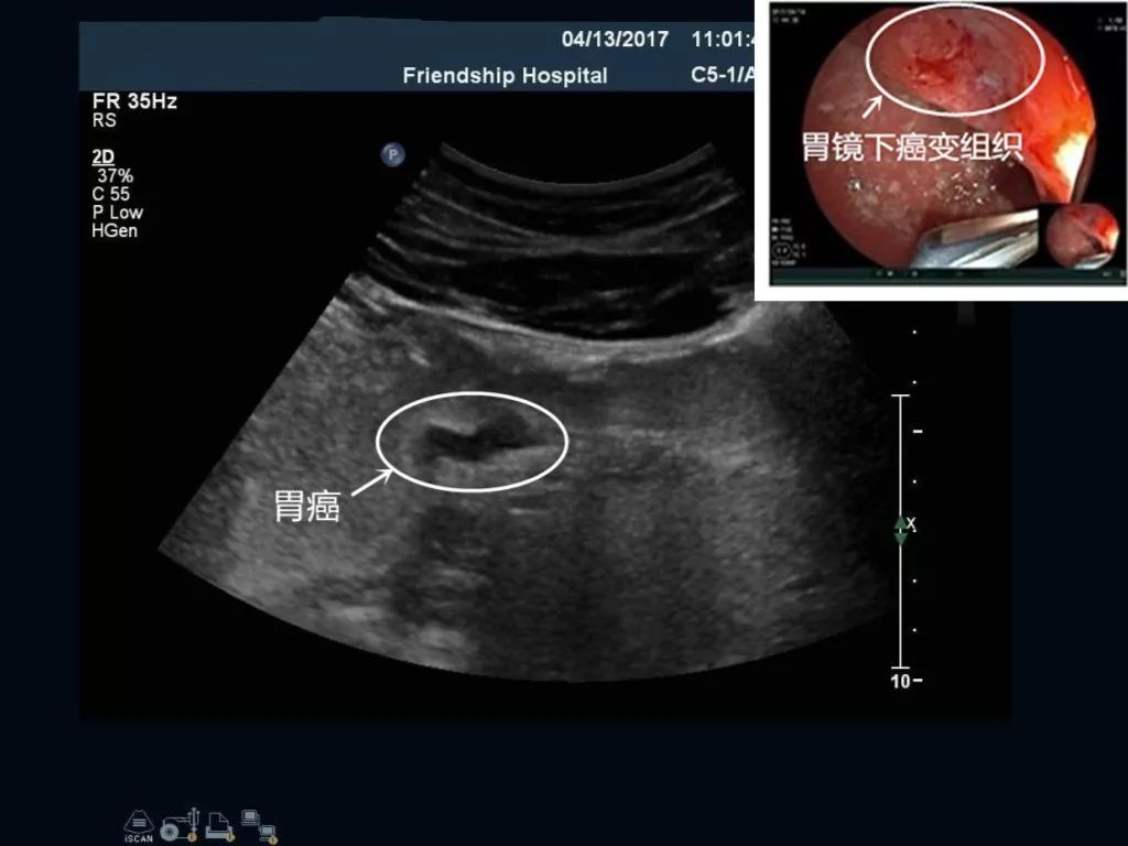 刚做完胃镜能做胃超声吗,友谊消化科普