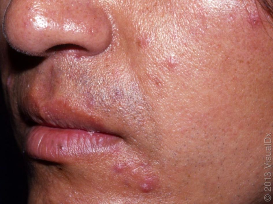 哪种皮肤病容易被误判为银屑病,容易被误诊为疥疮的皮肤病