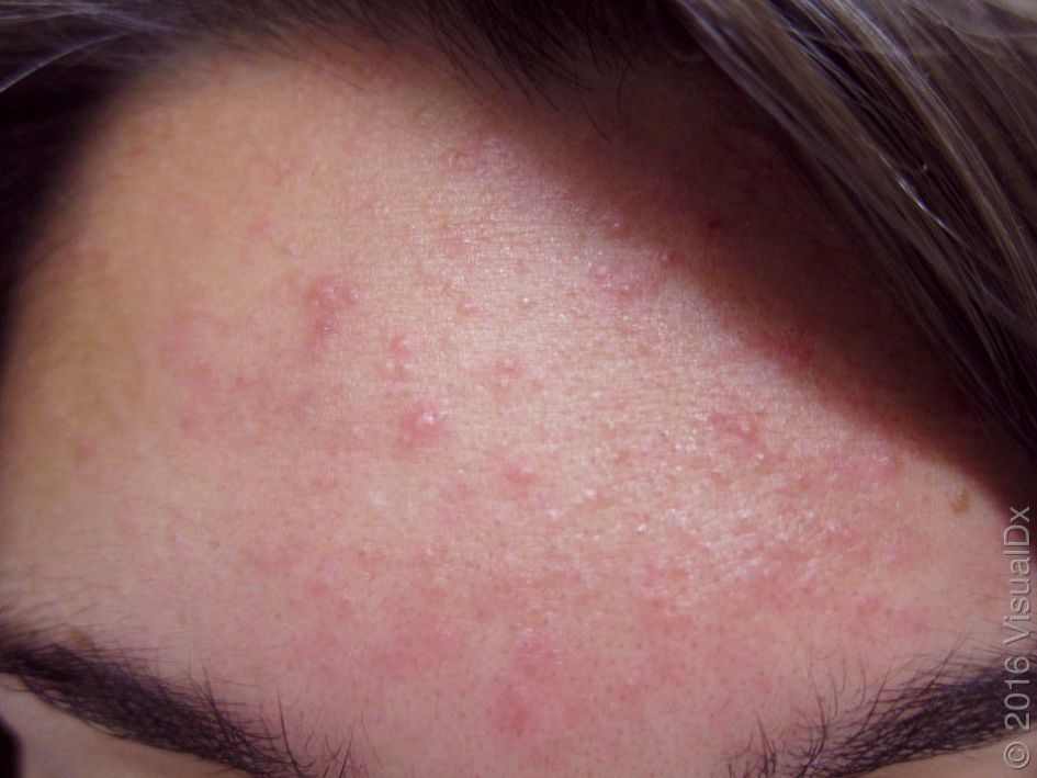 哪种皮肤病容易被误判为银屑病,容易被误诊为疥疮的皮肤病