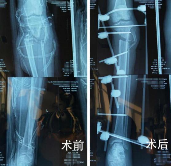 小腿部分断裂保守治疗,小腿离断再植康复训练