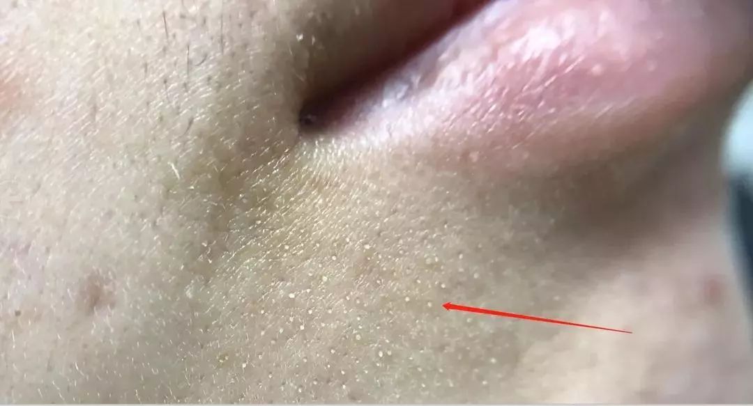 怎么把脸上的黑头清掉,去黑头推荐全脸