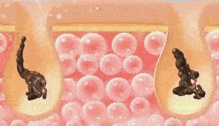 皮肤清洁出黑色的东西,皮肤挤出白色膏状很臭怎么办