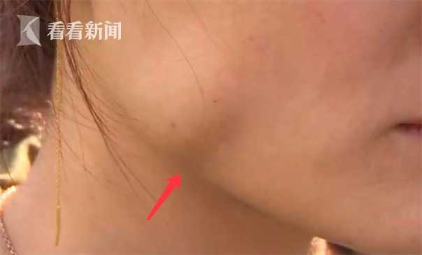 女子注射瘦脸针变成30岁的脸,注射瘦脸针后脸型变了