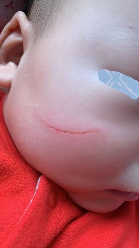 面部伤口美容缝合后注意事项,面部美容缝合视频