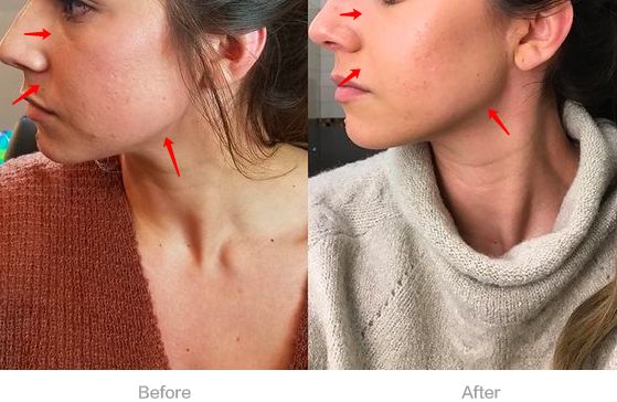 不削骨改变脸型,不削骨变脸型