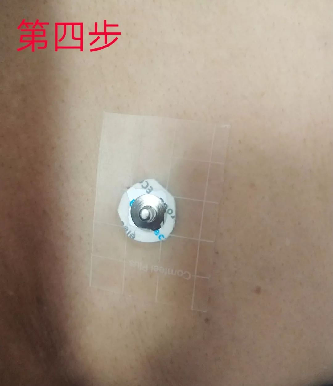 电极片皮试过敏,电极贴过敏的整改措施