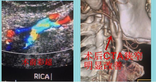 做了这个手术，肖大爷的白发变黑了……