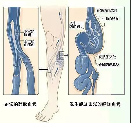 静脉曲张科普视频,关于下肢静脉曲张你知道多少