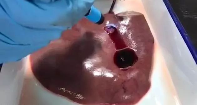 新型神奇胶水,新型生物胶水止血