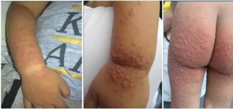 手足口病高发怎么防护看这里,现在是手足口病高发季怎么预防