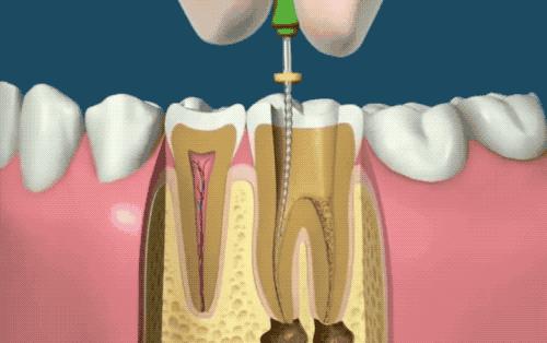 根管治疗没那么可怕,根管治疗有什么意义吗