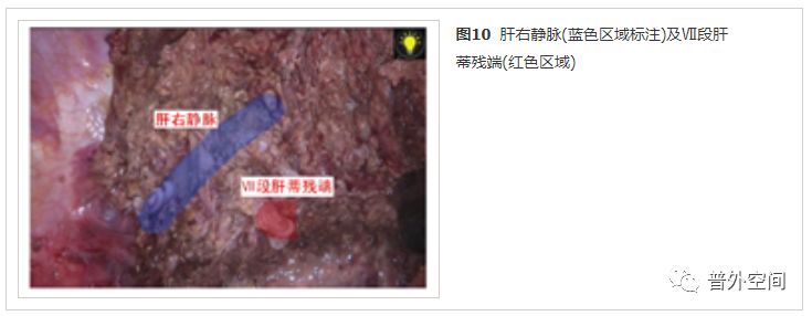 吲哚菁绿荧光引导腹腔镜解剖性肝脏Ⅶ段切除手术流程