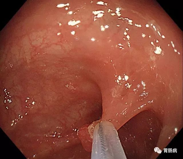 结肠息肉切除术术前准备,结肠镜下息肉冷切除术
