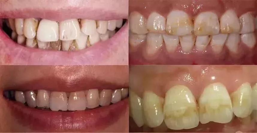 去除黄牙牙垢的牙膏,去口臭黄牙牙垢的牙膏