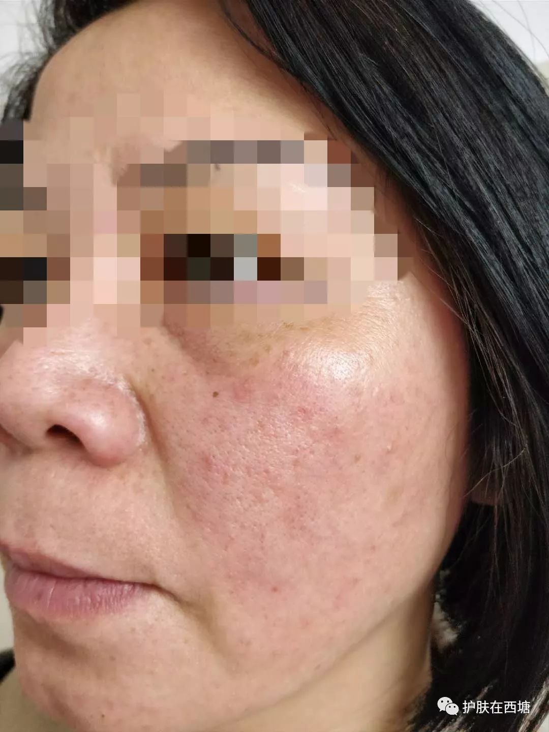 激素依赖性皮炎反复出疹子怎么办,激素依赖性皮炎好了以后怎么护肤