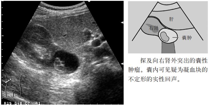 肾盏憩室和肾囊肿b超表现,肾盏憩室误诊肾囊肿案例