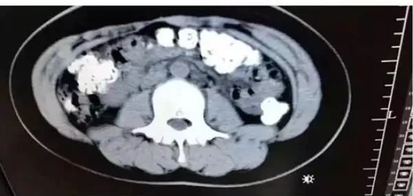 14岁女孩肚子疼,CT检查发现胃、肠、一直到…密密麻麻全是阴影