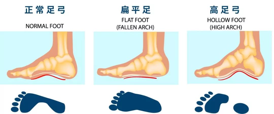 一穿鞋子就烂脚丫,鞋子磨脚解决小妙招好物分享