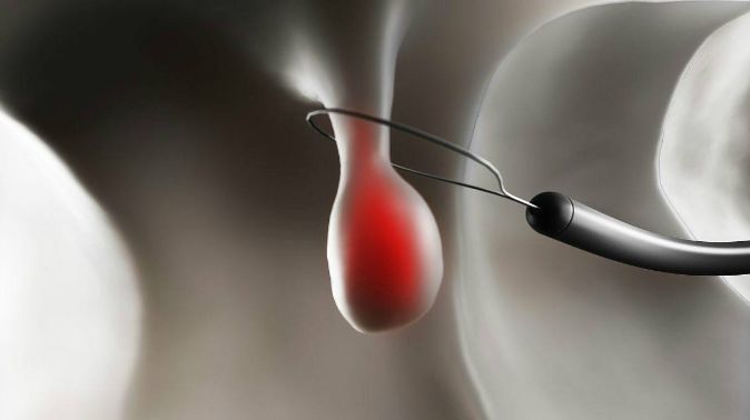 息肉和囊肿哪个容易癌变,宫颈囊肿息肉会癌变吗