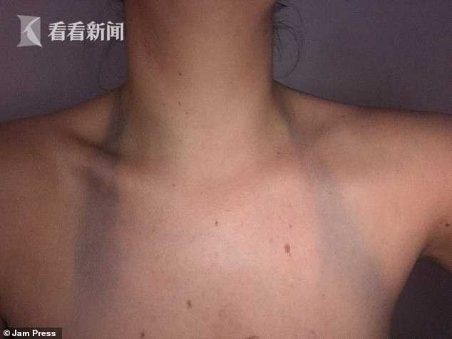 女子买了件黑色泳衣穿了10分钟还没下水胸部染出两条黑色印记