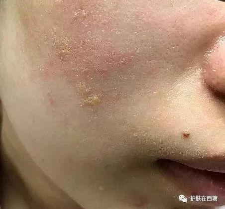 头皮脂溢性皮炎怎么彻底根除,毛囊炎和脂溢性皮炎的区别图