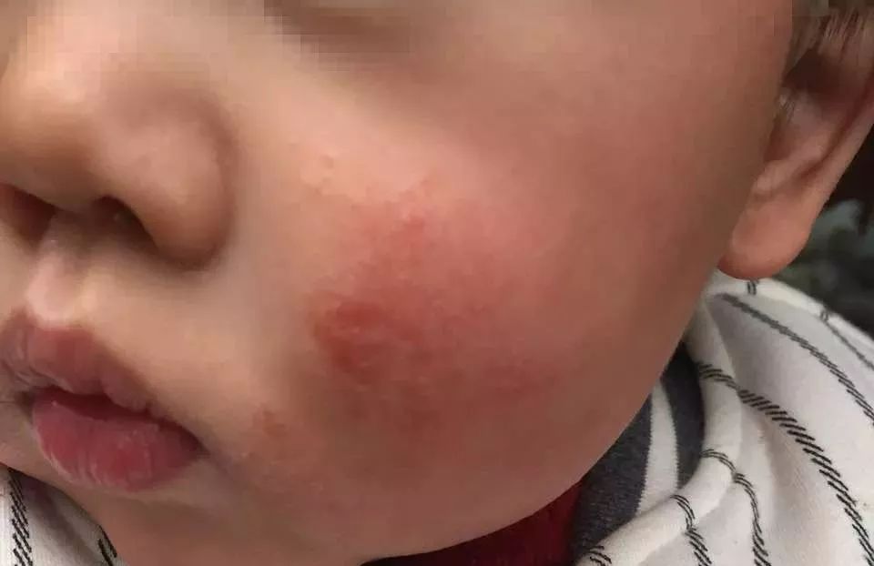 头皮脂溢性皮炎怎么彻底根除,毛囊炎和脂溢性皮炎的区别图