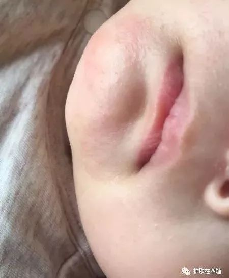 他克莫司软膏治疗脂溢性皮炎,面部皮肤脂溢性皮炎治疗方法