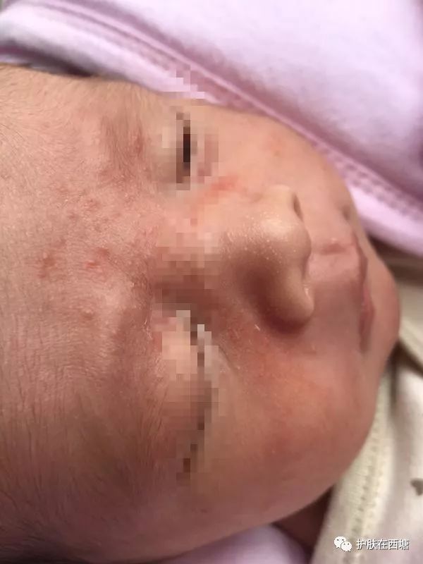 头皮脂溢性皮炎怎么彻底根除,毛囊炎和脂溢性皮炎的区别图