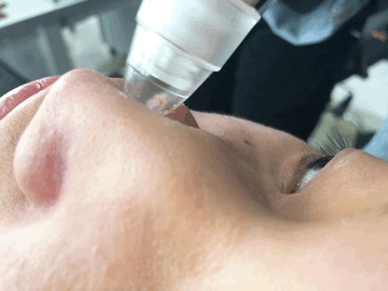 草莓鼻救星怎么治疗,草莓鼻去黑头神器视频