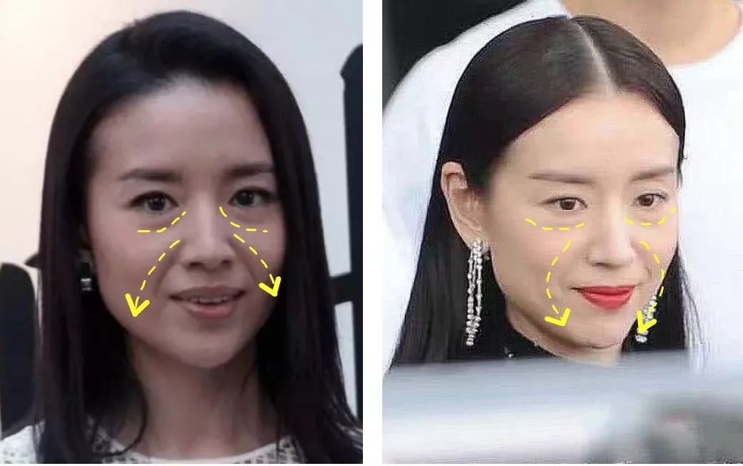 不削骨改变脸型,不削骨变脸型