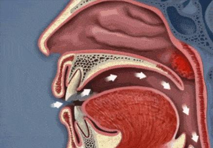 打呼噜其实是一种病,打呼噜是一种病吗有药可治吗