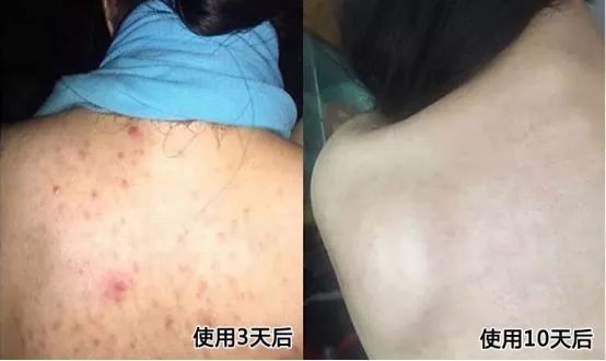 鸡皮肤永久消除,37天快速祛鸡皮肤