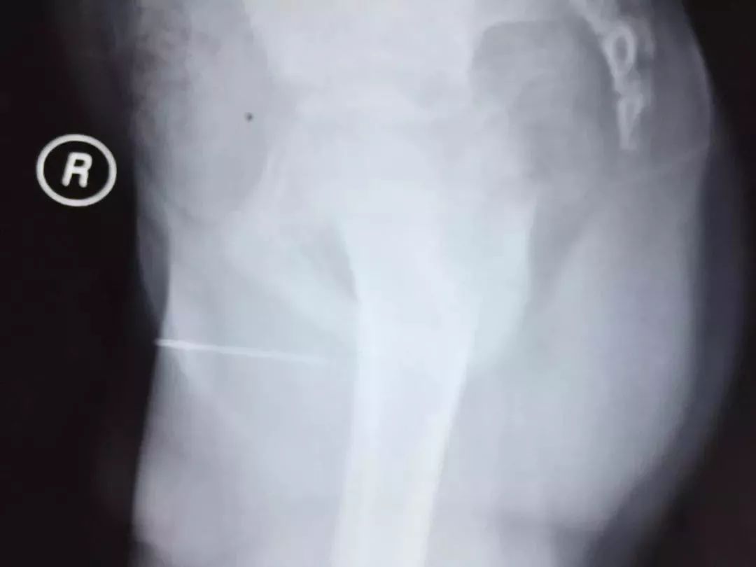 看着就很痛!广西一男孩竟将4.5厘米长缝衣针塞入*体下**…