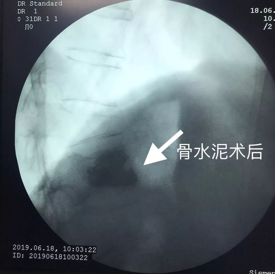 骨科科普压缩性骨折,陈旧性压缩骨折和新近压缩骨折