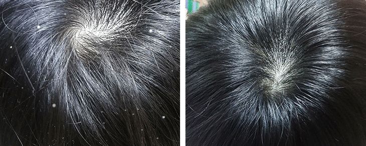 听说90后已经开始脱发了,听说第一批90后已经开始脱发了