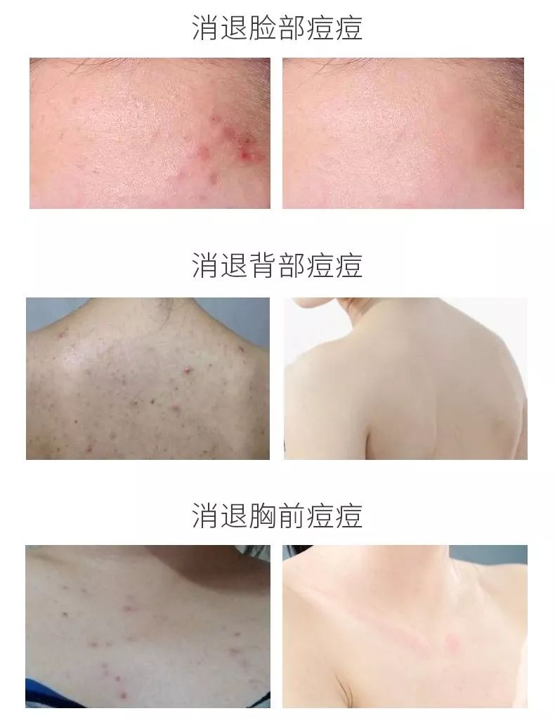 教你1分钟清除99%的脸上螨虫,10秒祛螨虫的药膏