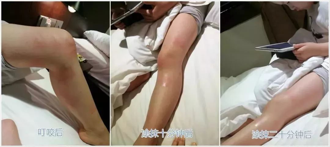 补水保湿晒后修复消炎杀菌,芦荟胶舒缓保湿凝胶儿童可以用吗