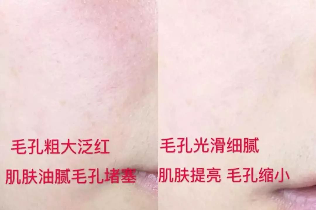 拯救毛孔黑头,清除黑头大毛孔的利器