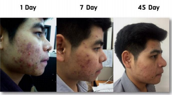 断货王祛痘胶囊,秒杀祛痘化妆品一元