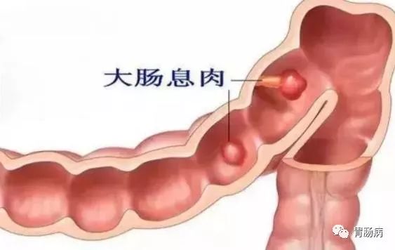 全面解读：结直肠息肉