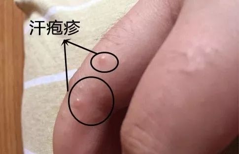 手指上有小水泡是脚气吗,手指上起小水泡就一定是汗疱疹吗