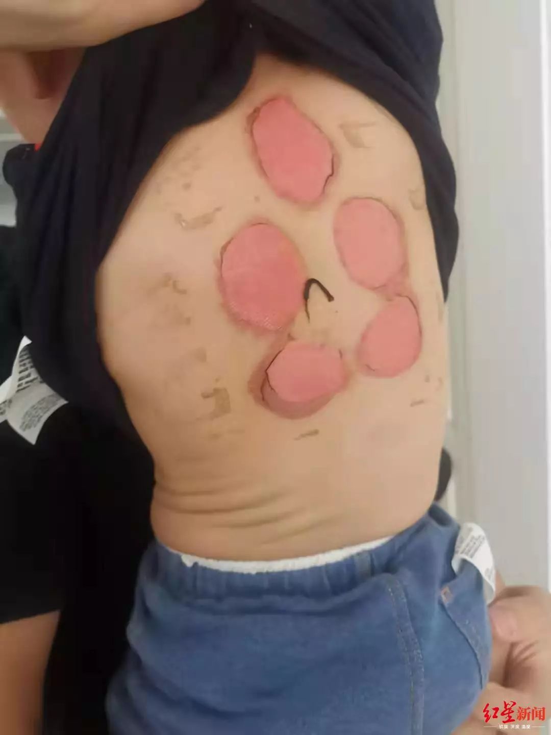 92名儿童被三伏贴灼伤看着心疼,92名儿童贴三伏后被烧伤